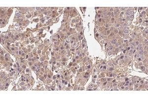 ABIN6269008 at 1/100 staining Human liver cancer tissue by IHC-P. (GLUT1 antibody  (C-Term))
