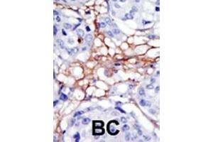 Formalin-fixed and paraffin-embedded human cancer tissue reacted with the primary antibody, which was peroxidase-conjugated to the secondary antibody, followed by DAB staining. (PIP4K2A antibody  (N-Term))