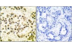 Immunohistochemistry analysis of paraffin-embedded human breast carcinoma, using STAT5B (Phospho-Ser731) Antibody.