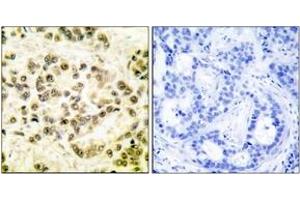 Immunohistochemistry analysis of paraffin-embedded human breast carcinoma, using STAT5B (Phospho-Ser731) Antibody. (STAT5B antibody  (pSer731))