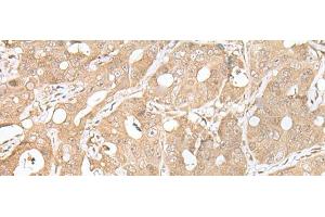 Immunohistochemistry of paraffin-embedded Human gastric cancer tissue using SMARCA1 Polyclonal Antibody at dilution of 1:30(x200) (SMARCA1 antibody)