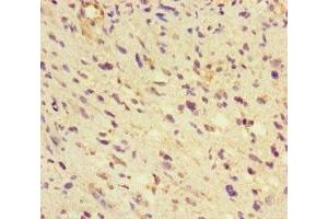 Immunohistochemistry of paraffin-embedded human glioma using ABIN7154022 at dilution of 1:100 (GLUL antibody  (AA 86-373))