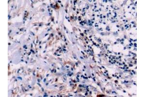 Detection of Bcl2 in Human Lymphoma Tissue using Polyclonal Antibody to B-Cell Leukemia/Lymphoma 2 (Bcl2) (Bcl-2 antibody  (AA 2-211))