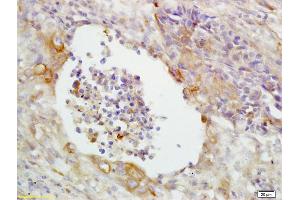 Formalin-fixed and paraffin embedded human lung carcinoma labeled with Anti-CD14 Polyclonal Antibody, Unconjugated (ABIN673164) at 1:200 followed by conjugation to the secondary antibody and DAB staining (CD14 antibody  (AA 201-300))