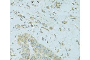Immunohistochemistry of paraffin-embedded Human breast cancer using MTFP1 Polyclonal Antibody at dilution of 1:100 (40x lens). (Mtfp1 antibody)