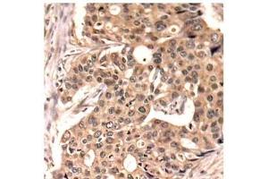 Immunohistochemistry of paraffin-embedded Human breast carcinoma tissue, using Phospho-PXN(Y118) Polyclonal Antibody (Paxillin antibody  (pTyr118))
