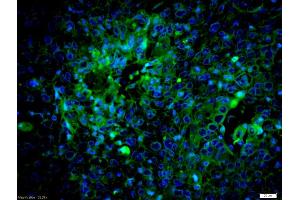 Formalin-fixed and paraffin embedded human laryngocarcinoma labeled with Anti-caspase-8 subunit p18 Polyclonal Antibody, Unconjugated (ABIN1386778) at 1:200 followed by conjugation to the secondary antibody Goat Anti-Rabbit IgG, AF488 conjugated used at 1:200 dilution for 40 minutes at 37°C and DAPI staining (Caspase 8 antibody  (AA 188-280))