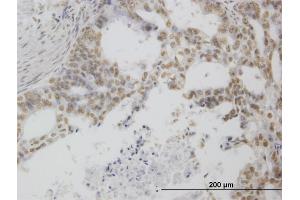 Immunoperoxidase of monoclonal antibody to POLR1C on formalin-fixed paraffin-embedded human pancreatic cancer. (POLR1C antibody  (AA 1-346))