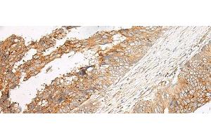 Immunohistochemistry of paraffin-embedded Human colorectal cancer tissue using GPR17 Polyclonal Antibody at dilution of 1:25(x200) (GPR17 antibody)