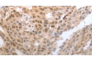 Immunohistochemistry of paraffin-embedded Human esophagus cancer tissue using SLC22A8 Polyclonal Antibody at dilution 1:70 (SLC22A8 antibody)