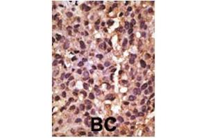 Formalin-fixed and paraffin-embedded human cancer tissue reacted with the primary antibody, which was peroxidase-conjugated to the secondary antibody, followed by DAB staining. (BNIP3 antibody  (AA 215-252))