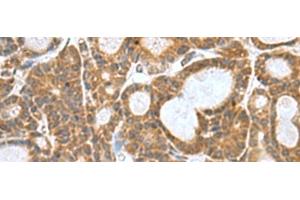 Immunohistochemistry of paraffin-embedded Human thyroid cancer tissue using KANSL1L Polyclonal Antibody at dilution of 1:80(x200) (KANSL1L antibody)