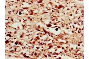 IHC image of ABIN7156872 diluted at 1:1400 and staining in paraffin-embedded human melanoma performed on a Leica BondTM system. (IL-24 antibody  (AA 52-207))