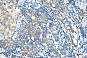 Immunohistochemistry was performed on paraffin-embedded human breast carcinoma using dynamin 2 antibody (ABIN7798399), 1:200).