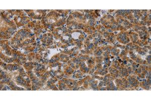 Immunohistochemistry of paraffin-embedded Human thyroid cancer tissue using HSD17B14 Polyclonal Antibody at dilution 1:40 (HSD17B14 antibody)