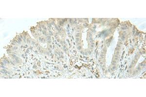Immunohistochemistry of paraffin-embedded Human thyroid cancer tissue using C8orf4 Polyclonal Antibody at dilution of 1:55(x200) (C8orf4 antibody)