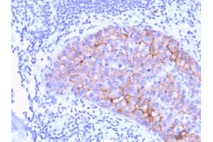 Formalin-fixed, paraffin-embedded human Breast Carcinoma stained with HER-2 Mouse Monoclonal Antibody (ERBB2/3078). (ErbB2/Her2 antibody  (AA 311-462))