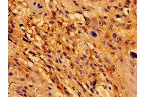 Immunohistochemistry of paraffin-embedded human cervical cancer using ABIN7172450 at dilution of 1:100 (TCF15 antibody  (AA 24-199))