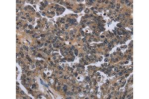 Immunohistochemistry of Human ovarian cancer using ITGAE Polyclonal Antibody at dilution of 1:50