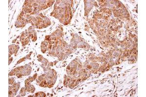 IHC-P Image ARF5 antibody detects ARF5 protein at cytosol on human breast carcinoma by immunohistochemical analysis.