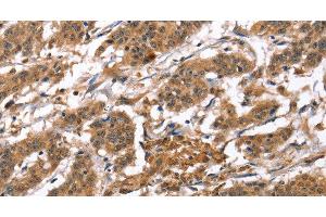 Immunohistochemistry of paraffin-embedded Human gastric cancer tissue using BNIP2 Polyclonal Antibody at dilution 1:50 (BNIP2 antibody)