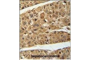 RT4I1 Antibody (C-term) (ABIN654729 and ABIN2844417) immunohistochemistry analysis in formalin fixed and paraffin embedded human hepatocarcinoma followed by peroxidase conjugation of the secondary antibody and DAB staining. (RTN4IP1 antibody  (C-Term))