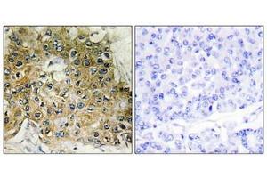 Immunohistochemical analysis of paraffin-embedded human breast carcinoma tissue using Integrin β1 (Phospho-Thr789) antibody (left)or the same antibody preincubated with blocking peptide (right). (ITGB1 antibody  (pThr789))