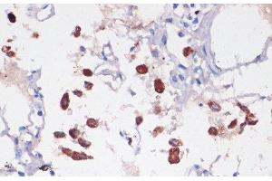 Immunohistochemistry of paraffin-embedded Human lung using CD68 Polyclonal Antibody at dilution of 1:100 (40x lens).