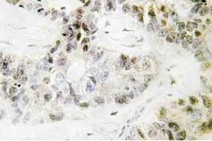 Immunohistochemistry (IHC) analyzes of Pitx1 antibody in paraffin-embedded human lung carcinoma tissue. (PITX1 antibody)