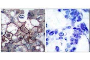 Immunohistochemical analysis of paraffin-embedded human breast carcinoma tissue, using (EGFR antibody  (pTyr1197))