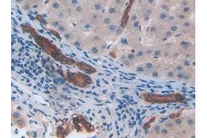 IHC-P analysis of Human Liver cancer Tissue, with DAB staining. (CXCL2 antibody  (AA 34-107))