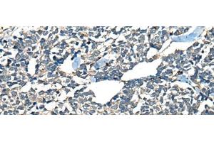 Immunohistochemistry of paraffin-embedded Human lung cancer tissue using CDADC1 Polyclonal Antibody at dilution of 1:60(x200) (CDADC1 antibody)