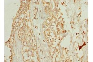 Immunohistochemistry of paraffin-embedded human breast cancer using ABIN7175750 at dilution of 1:100 (WDR38 antibody  (AA 1-314))