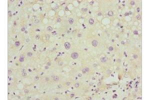 Immunohistochemistry of paraffin-embedded human liver cancer using ABIN7162977 at dilution of 1:100 (PEX14 antibody  (AA 118-377))
