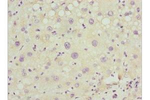 Immunohistochemistry of paraffin-embedded human liver cancer using ABIN7162977 at dilution of 1:100