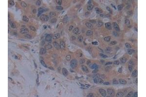 Detection of TICAM1 in Human Breast cancer Tissue using Polyclonal Antibody to Toll Like Receptor Adaptor Molecule 1 (TICAM1) (TICAM1 antibody  (AA 443-685))