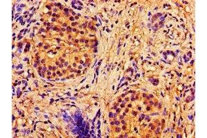 Immunohistochemistry of paraffin-embedded human pancreatic cancer using ABIN7144893 at dilution of 1:100 (ABCB7 antibody  (AA 23-140))