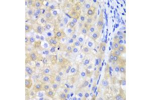 Immunohistochemistry of paraffin-embedded human liver cancer using FTH1 antibody at dilution of 1:100 (400x lens). (FTH1 antibody)
