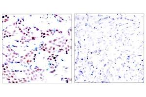 Immunohistochemical analysis of paraffin-embedded human breast carcinoma tissue using c-Jun (phospho-Thr91) antibody (E011021). (C-JUN antibody  (pThr91))