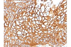 Formalin-fixed, paraffin-embedded human Basal Cell Carcinoma stained with CD9 Mouse Monoclonal Antibody (CD9/1619). (CD9 antibody)