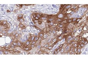 ABIN6273988 at 1/100 staining Human Head and neck cancer tissue by IHC-P.