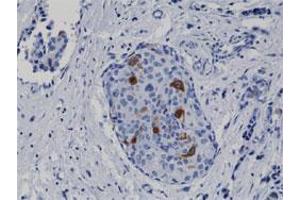 Immunohistochemical staining (Formalin-fixed paraffin-embedded sections) of human breast cancer with CCNB1 monoclonal antibody, clone RM281 . (Cyclin B1 antibody)