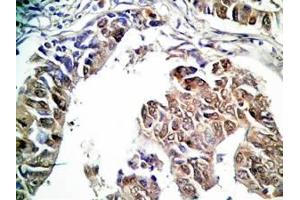 Human stomach cancer tissue was stained by rabbit Anti-Spexin prepro (36-58)  (H) Antibody (Spexin antibody  (Preproprotein))