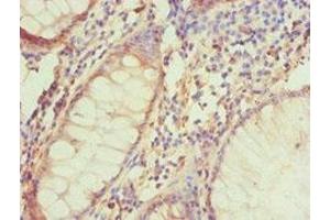 Immunohistochemistry of paraffin-embedded human colon cancer using ABIN7145332 at dilution of 1:100