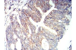 Immunohistochemical analysis of paraffin-embedded rectum cancer tissues using CD166 mouse mAb with DAB staining. (CD166 antibody  (AA 227-381))