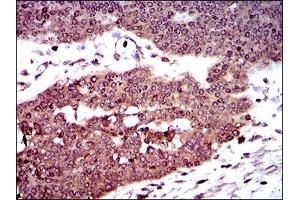 Immunohistochemical analysis of paraffin-embedded ovarian cancer tissues using DCTN4 mouse mAb with DAB staining. (Dynactin 4 antibody  (AA 57-298))