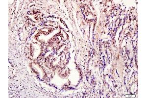 Paraformaldehyde-fixed, paraffin embedded human stomach cancer tissue, Antigen retrieval by boiling in sodium citrate buffer(pH6) for 15min, Block endogenous peroxidase by 3% hydrogen peroxide for 30 minutes, Blocking buffer (normal goat serum) at 37°C for 20min, Antibody incubation with Rabbit Anti-STAT3 (Tyr705) Polyclonal Antibody, Unconjugated  at 1:400 overnight at 4°C, followed by a conjugated secondary and DAB staining (STAT3 antibody  (pTyr705))