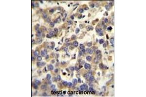 LYPD4 antibody (Center) (ABIN654302 and ABIN2844090) immunohistochemistry analysis in formalin fixed and paraffin embedded human testis carcinoma followed by peroxidase conjugation of the secondary antibody and DAB staining. (LYPD4 antibody  (AA 104-133))