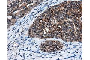 Immunohistochemical staining of paraffin-embedded Adenocarcinoma of breast tissue using anti-ELAVL1 mouse monoclonal antibody.