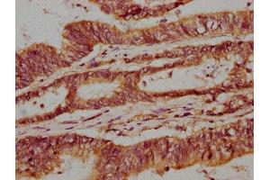 IHC image of ABIN7153701 diluted at 1:300 and staining in paraffin-embedded human colon cancer performed on a Leica BondTM system. (Mare/Nprl3/C16orf35 antibody  (AA 349-482))